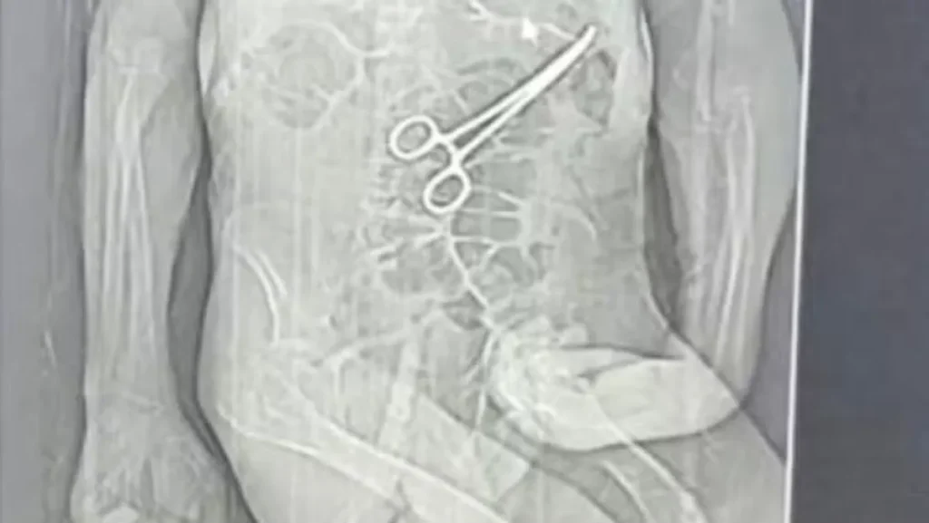 Investigação em MG: Idoso morre após pinça cirúrgica ser esquecida em seu corpo