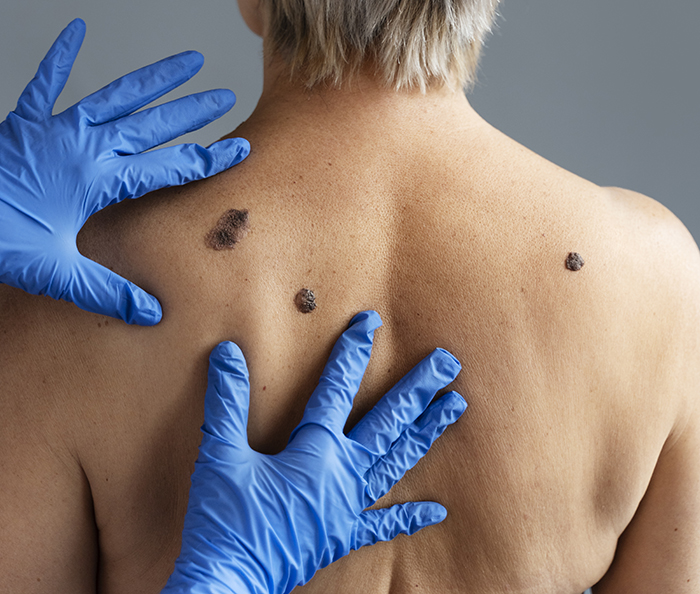 Verão em alerta: Dicas essenciais para a prevenção do câncer de pele e uso correto de protetor solar