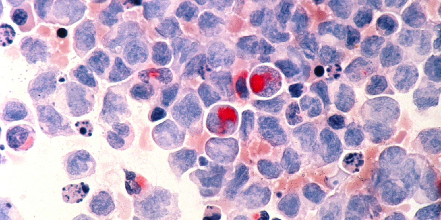 Fevereiro Laranja: A Importância da Doação de Medula e Conscientização sobre Leucemia Fevereiro Laranja: A Importância da Doação de Medula e Conscientização sobre Leucemia