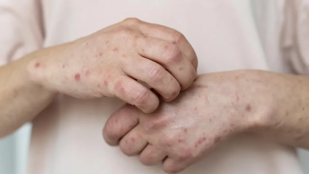 Rio de Janeiro Confirma Caso de Sarampo: Medidas de Saúde Imediatas em Ação